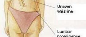 Scoliosis treatment