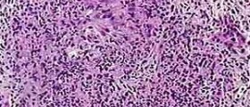Wegener's Granulomatosis: Diagnosis & Treatment