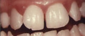 Bleeding Gums - Causes, Symptoms, Treatment