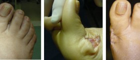 Bunion Removal (Bunionectomy): Preparing For Surgery and post OP recovery