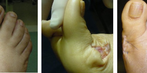 Bunion Removal (Bunionectomy): Preparing For Surgery and post OP recovery