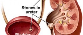 Kidney Stone Flush: Pros and cons