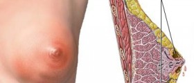 Breast infections - How to prevent mastitis?