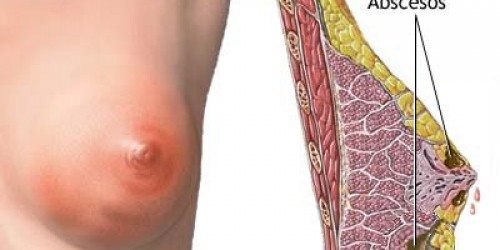 Breast infections - How to prevent mastitis?