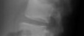 Osteomyelitis: Bone infection