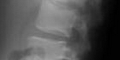 Osteomyelitis: Bone infection