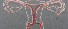 Polycystic Ovary Syndrome (PCOS): How to correct your hormonal imbalance?