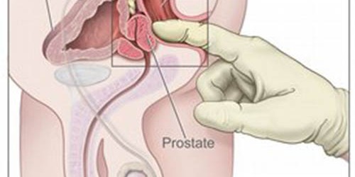 Urethritis: Symptoms, causes, and treatment