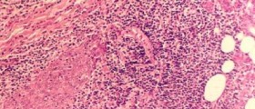 Sjogren's syndrome: Causes, Symptoms & Treatment