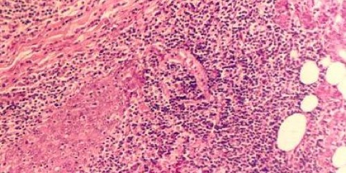 Sjogren's syndrome: Causes, Symptoms & Treatment