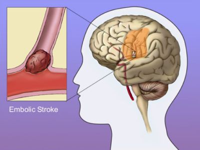 Stroke in young people  Men's Health articles  Family 