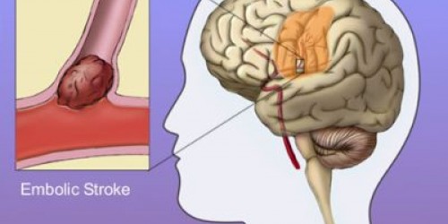 Stroke in young people