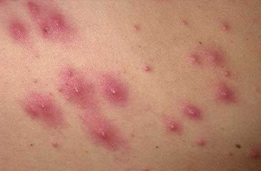 Folliculitis | Skin & Hair problems articles | Body ...