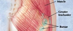 Hip Bursitis - Trochanteric Bursitis
