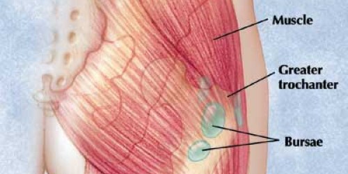 Hip Bursitis - Trochanteric Bursitis