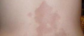 Morphea Scleroderma