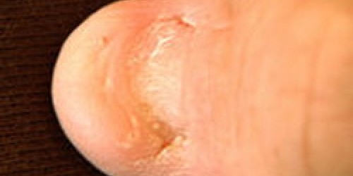 Nail Patella syndrome