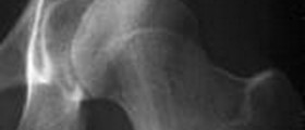 Snapping Hip Syndrome