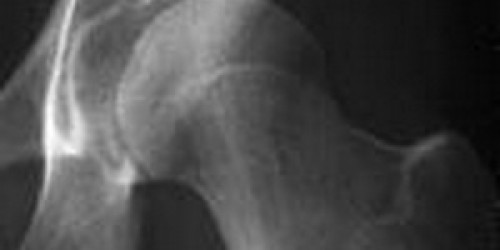 Snapping Hip Syndrome