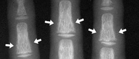 Renal Osteodystrophy