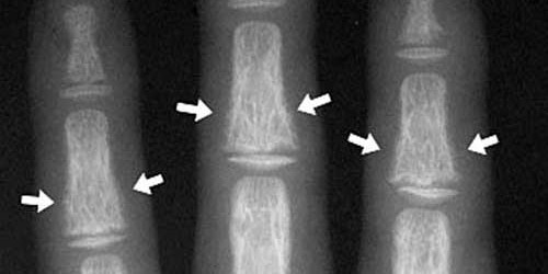 Renal Osteodystrophy