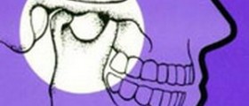 Temporomandibular Joint Syndrome