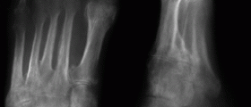 Reflex Sympathetic Dystrophy