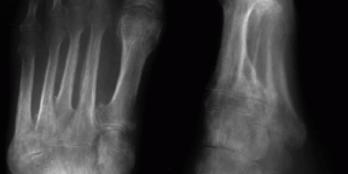 Reflex Sympathetic Dystrophy