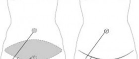 Tummy Tuck: Abdominoplasty procedure