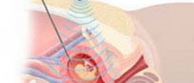 Down syndrome: Prenatal Screening During Pregnancy