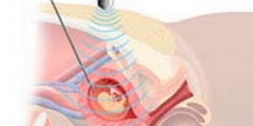 Down syndrome: Prenatal Screening During Pregnancy