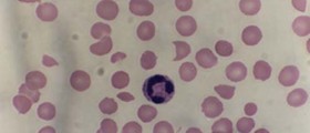 AIHA - Autoimmune Haemolytic Anaemia