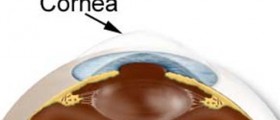 Recurrent Corneal Erosion Fact Sheet