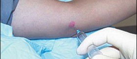 Most common uses of Corticosteroids
