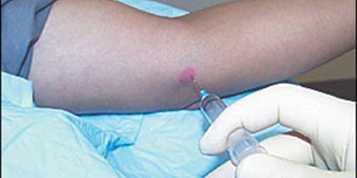 Most common uses of Corticosteroids