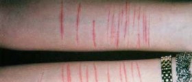 Self-Injury Disorder
