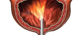 Cystoscopy: Pre and post procedure