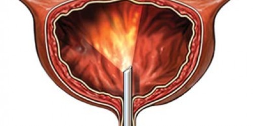 Cystoscopy: Pre and post procedure