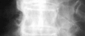 Diagnosed with DISH (Diffuse idiopathic skeletal hyperostosis)