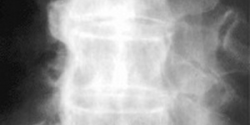 Diagnosed with DISH (Diffuse idiopathic skeletal hyperostosis)