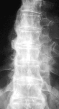 Diagnosed with DISH (Diffuse idiopathic skeletal hyperostosis