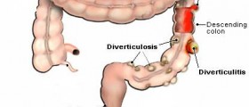 Diverticulitis: Causes, Risk Factors and Treatment