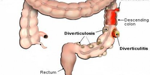 Diverticulitis: Causes, Risk Factors and Treatment