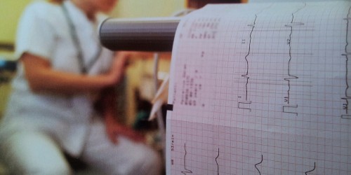 Atrial Fibrillation Treatment