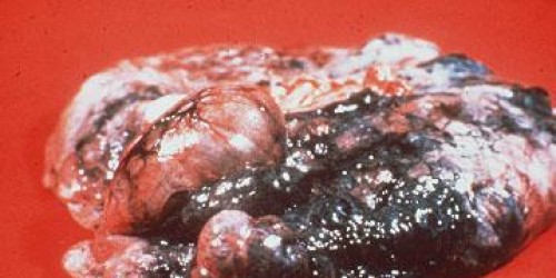 Lung Diseases: Emphysema & tobacco smoke