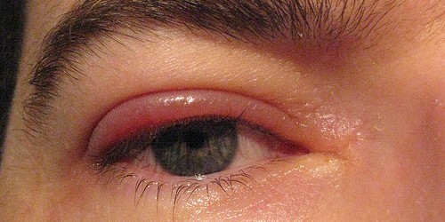 Staph infection in the eye | General center | SteadyHealth.com