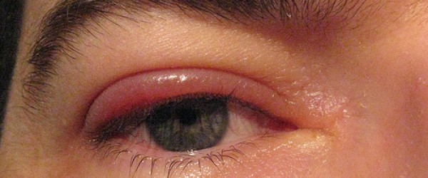 what-causes-swollen-eyelids-eye-disorders-and-diseases-medical