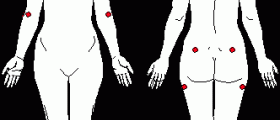 How to manage Fibromyalgia?