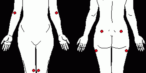 How to manage Fibromyalgia?