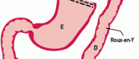 Gastric Bypass Surgery: The Best Slimming method